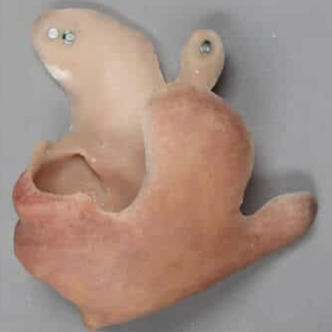 mandibulectomy prosthesis